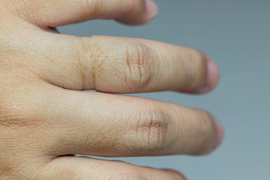 Man sieht Druckspuren eines entfernten Rings an einem Finger